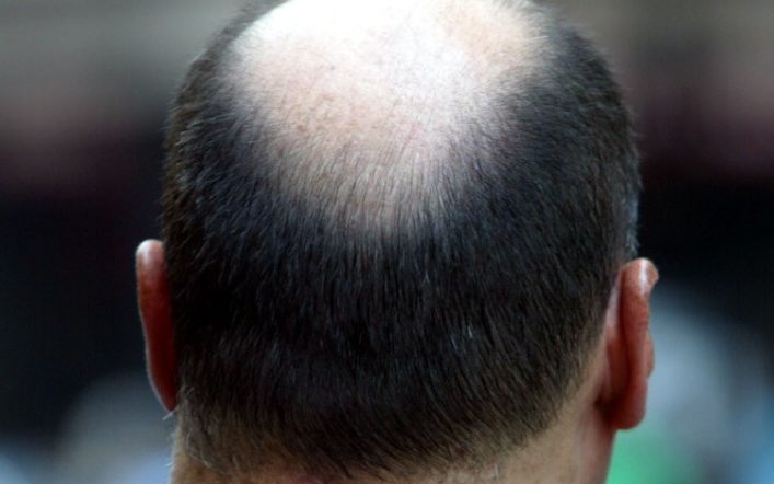 Trasplantes capilares en Turquía: la mejor solución para recuperar tu cabello